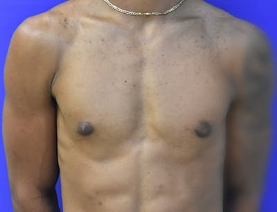 Gynecomastia Before & After Gallery - Patient 556776 - Image 2