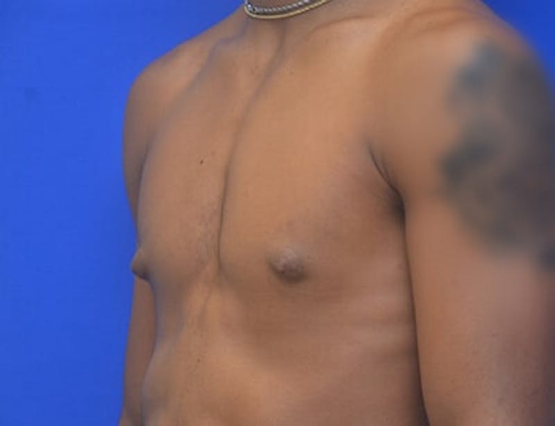 Gynecomastia Before & After Gallery - Patient 556776 - Image 3
