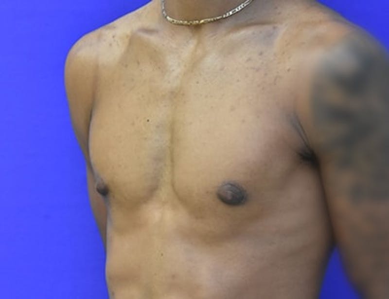 Gynecomastia Before & After Gallery - Patient 556776 - Image 4