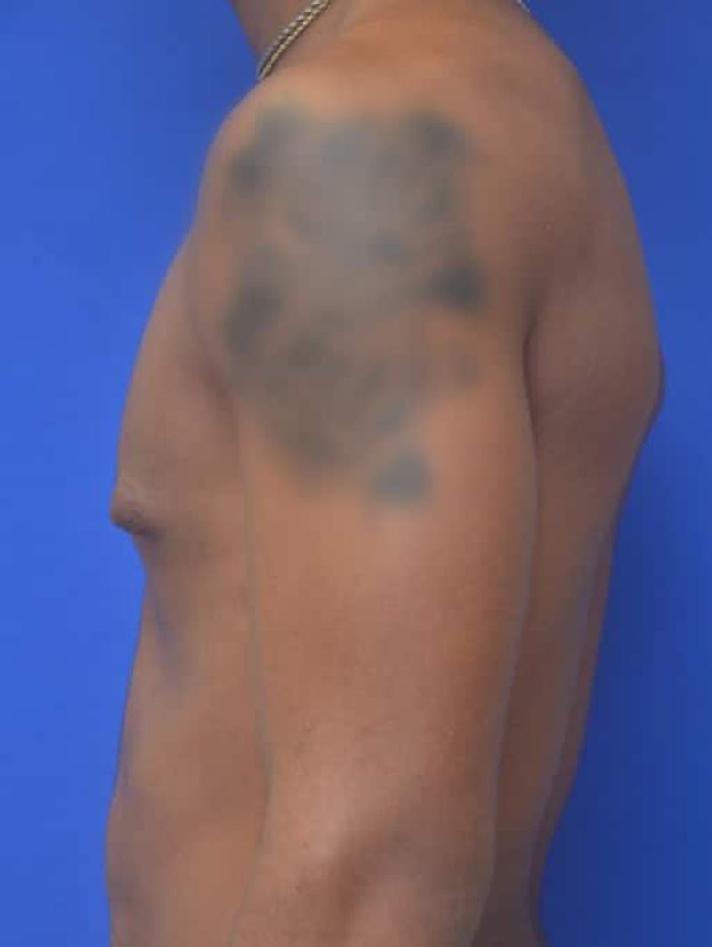 Gynecomastia Before & After Gallery - Patient 556776 - Image 5