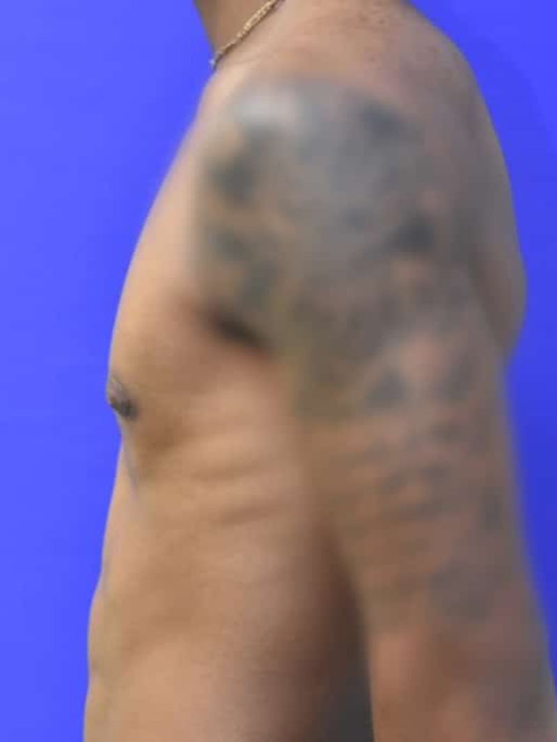 Gynecomastia Before & After Gallery - Patient 556776 - Image 6