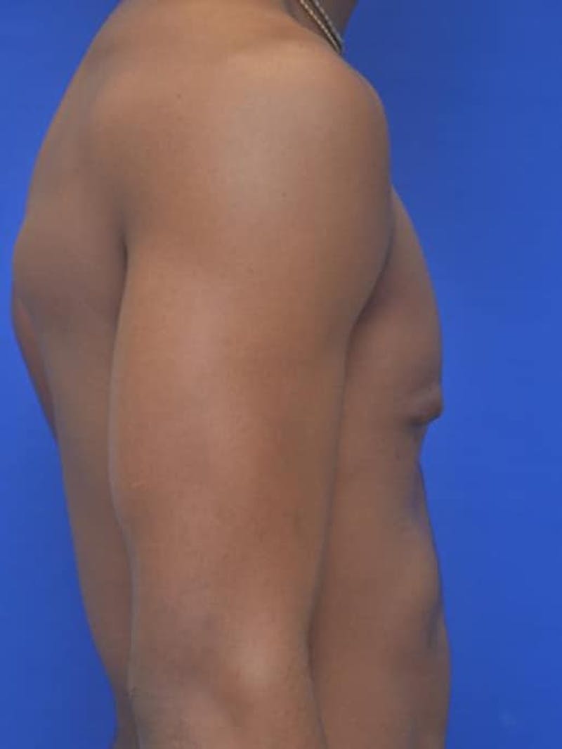 Gynecomastia Before & After Gallery - Patient 556776 - Image 7