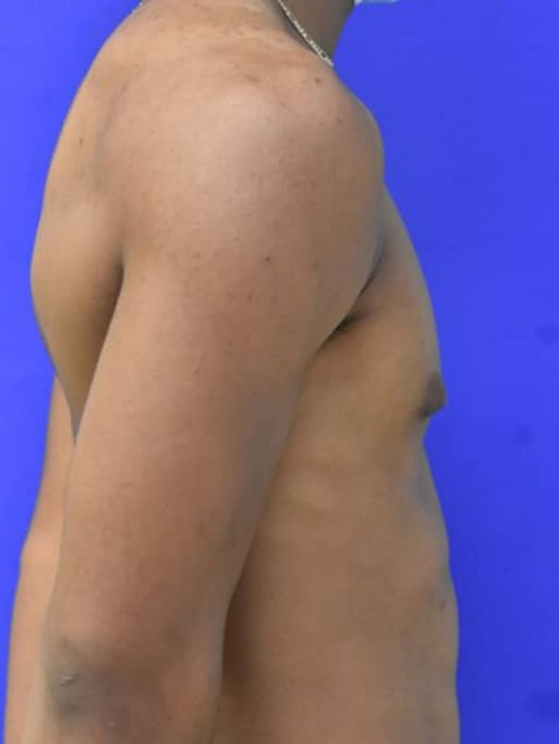 Gynecomastia Before & After Gallery - Patient 556776 - Image 8
