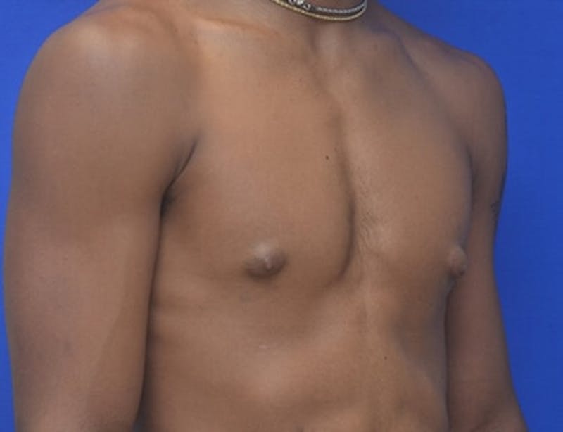 Gynecomastia Before & After Gallery - Patient 556776 - Image 9