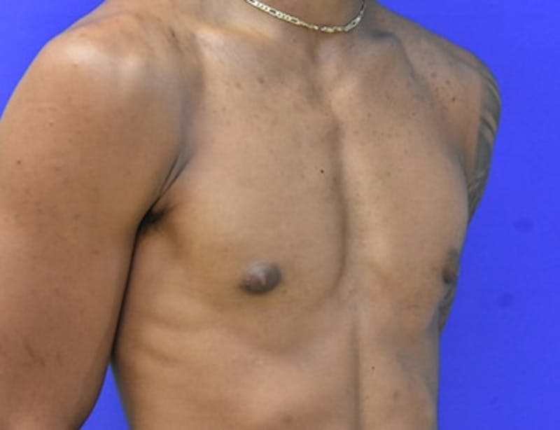Gynecomastia Before & After Gallery - Patient 556776 - Image 10