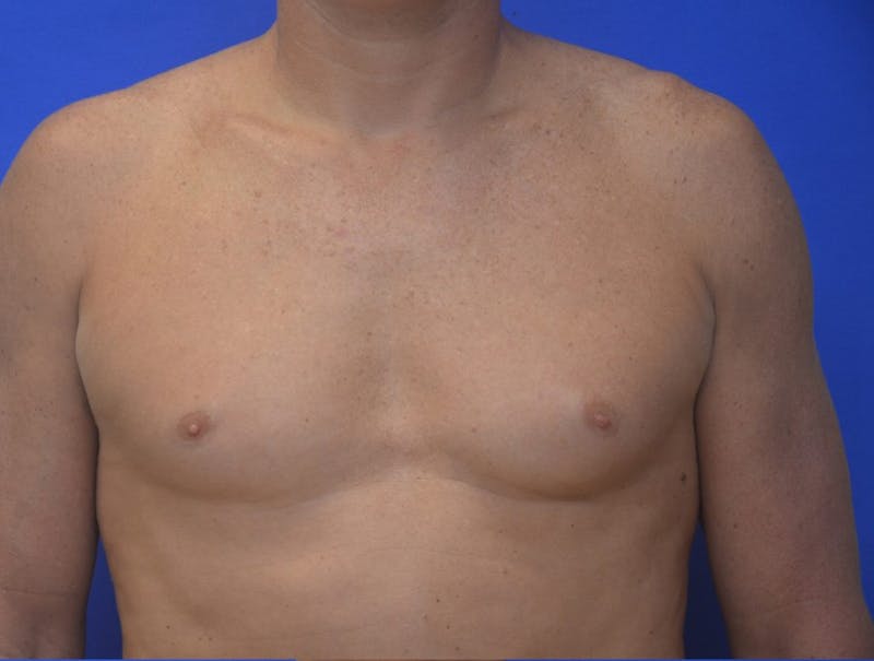Gynecomastia Before & After Gallery - Patient 255347 - Image 1