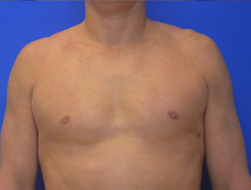 Gynecomastia Before & After Gallery - Patient 255347 - Image 2