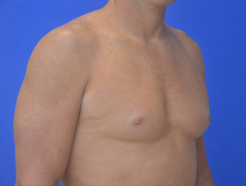 Gynecomastia Before & After Gallery - Patient 255347 - Image 3