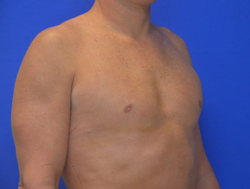 Gynecomastia Before & After Gallery - Patient 255347 - Image 4