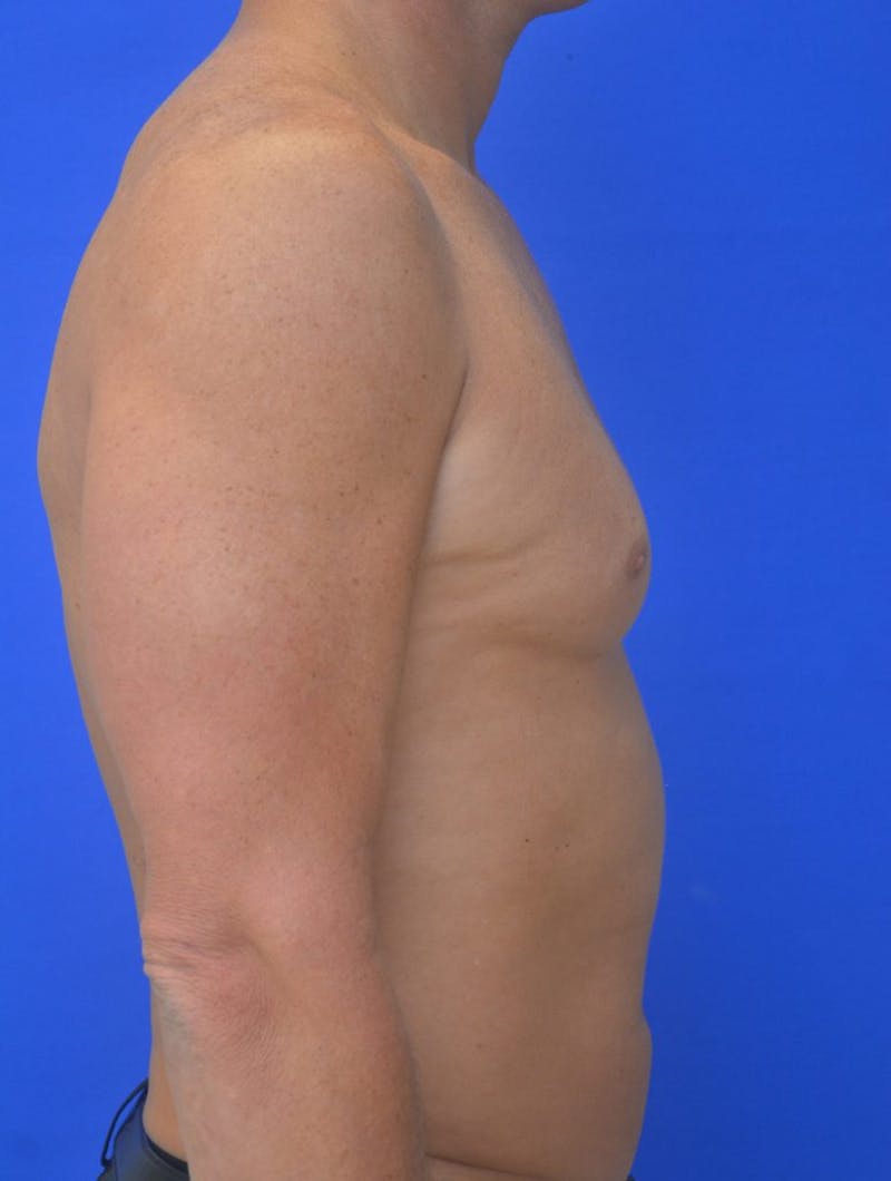 Gynecomastia Before & After Gallery - Patient 255347 - Image 5