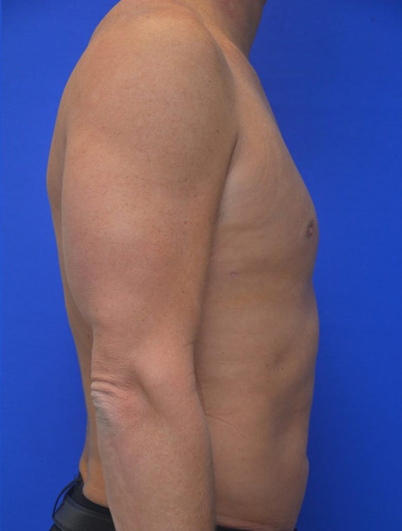 Gynecomastia Before & After Gallery - Patient 255347 - Image 6
