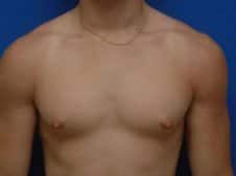 Gynecomastia Before & After Gallery - Patient 595838 - Image 1
