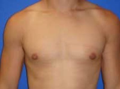 Gynecomastia Before & After Gallery - Patient 595838 - Image 2