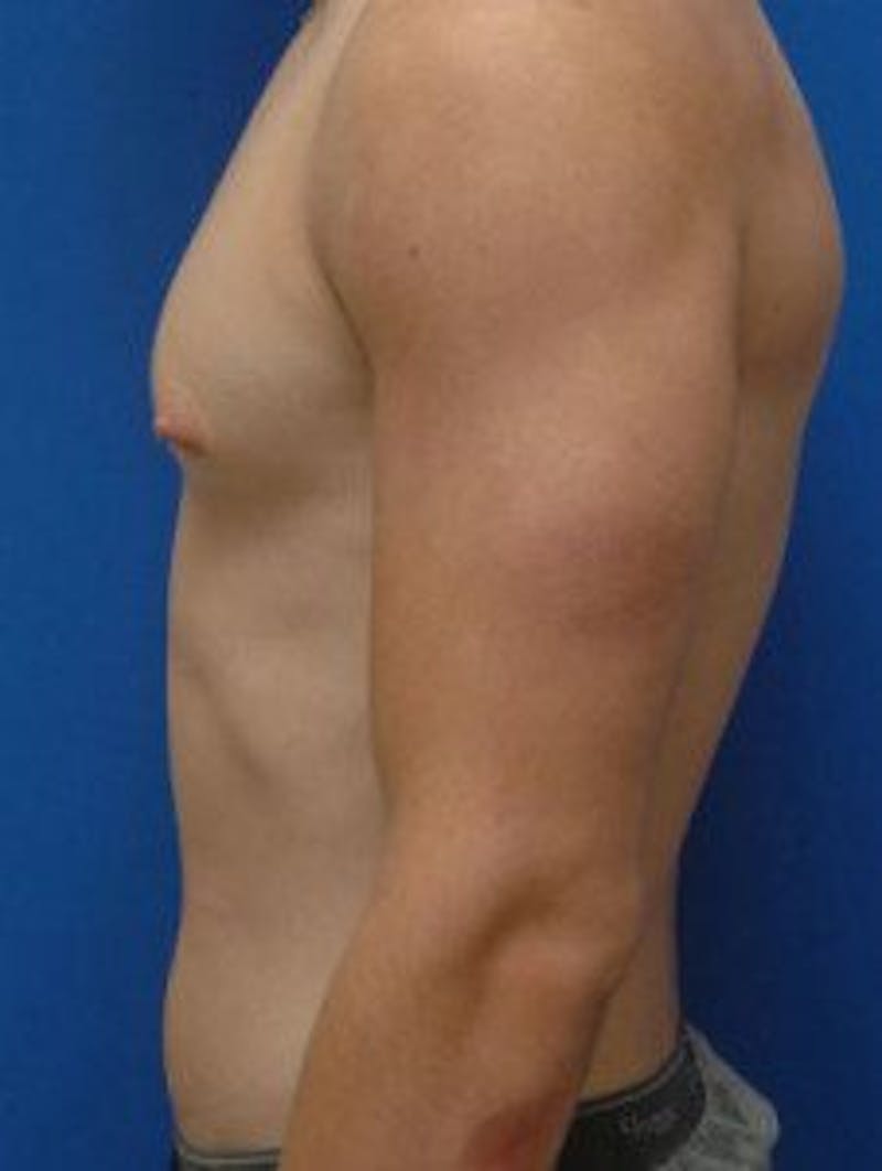 Gynecomastia Before & After Gallery - Patient 595838 - Image 3