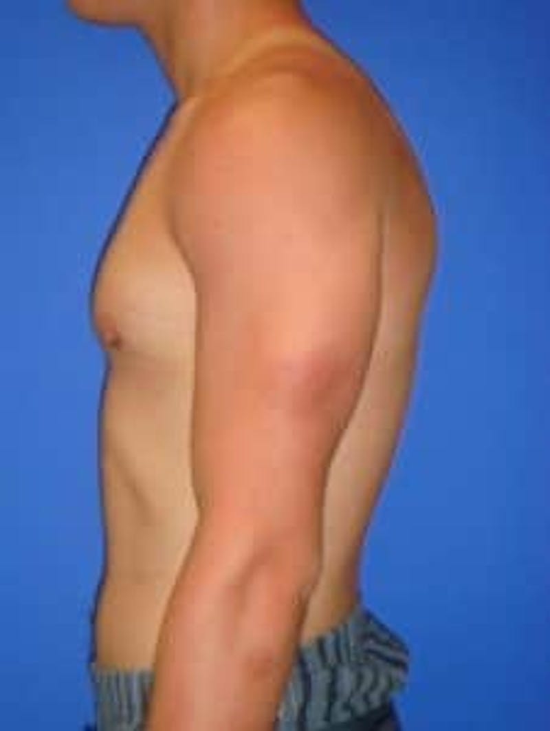Gynecomastia Before & After Gallery - Patient 595838 - Image 4