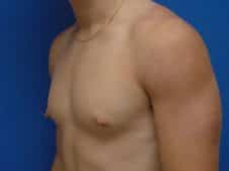 Gynecomastia Before & After Gallery - Patient 595838 - Image 5