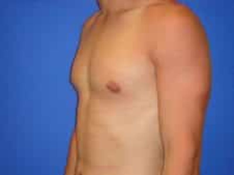 Gynecomastia Before & After Gallery - Patient 595838 - Image 6