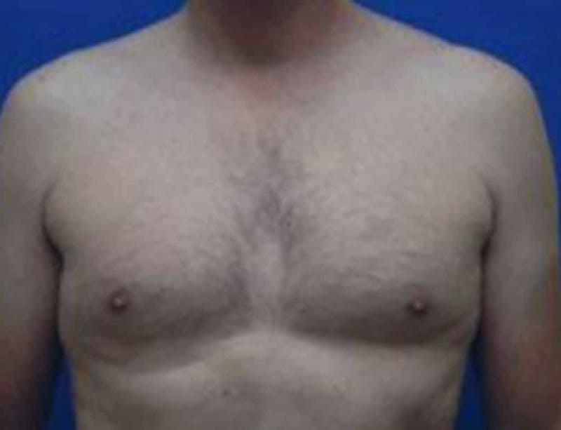 Gynecomastia Before & After Gallery - Patient 138521 - Image 1