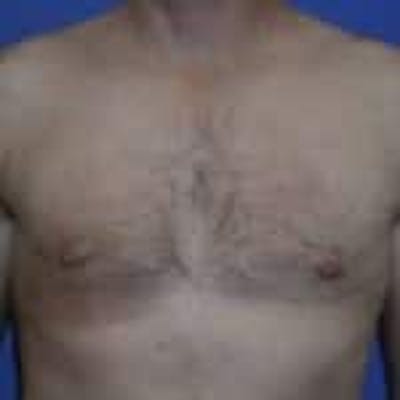 Gynecomastia Before & After Gallery - Patient 138521 - Image 2