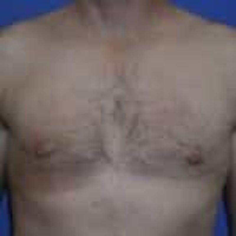Gynecomastia Before & After Gallery - Patient 138521 - Image 2
