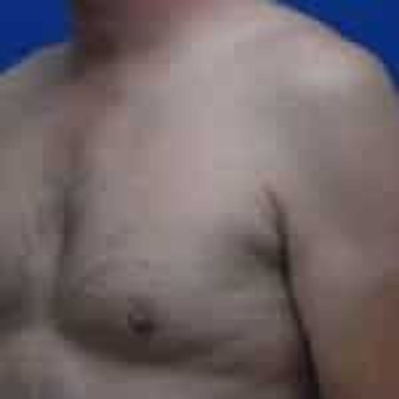 Gynecomastia Before & After Gallery - Patient 138521 - Image 3