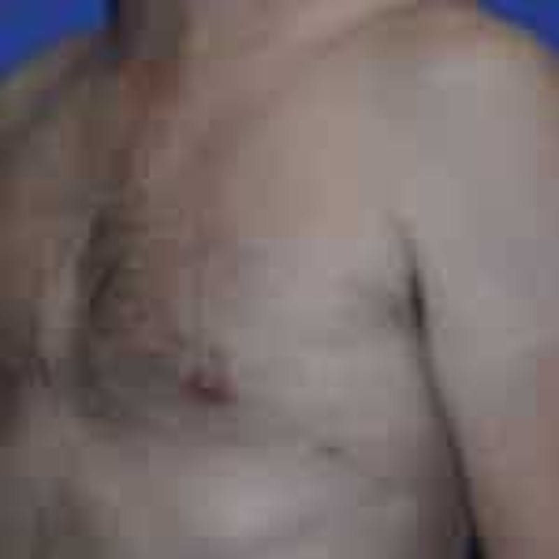 Gynecomastia Before & After Gallery - Patient 138521 - Image 4