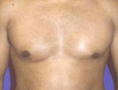 Gynecomastia Before & After Gallery - Patient 323071 - Image 1