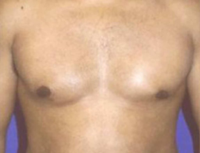 Gynecomastia Before & After Gallery - Patient 323071 - Image 1