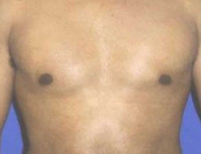 Gynecomastia Before & After Gallery - Patient 323071 - Image 2