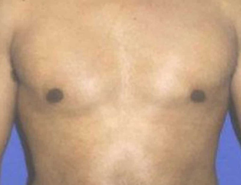 Gynecomastia Before & After Gallery - Patient 323071 - Image 2