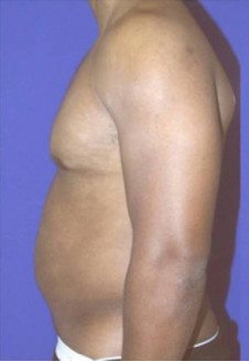 Liposuction Before & After Gallery - Patient 482114 - Image 3