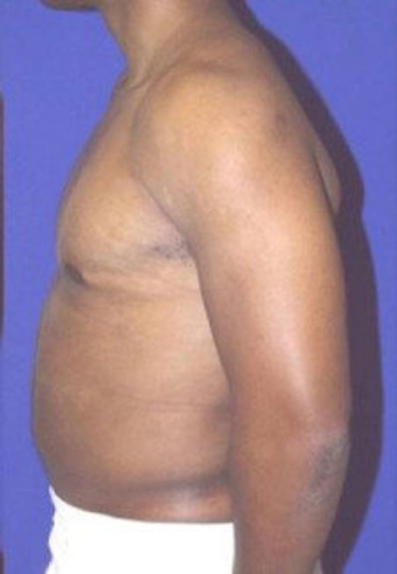Liposuction Before & After Gallery - Patient 482114 - Image 4