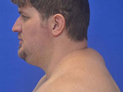 Buffalo Hump Before & After Gallery - Patient 389126 - Image 1