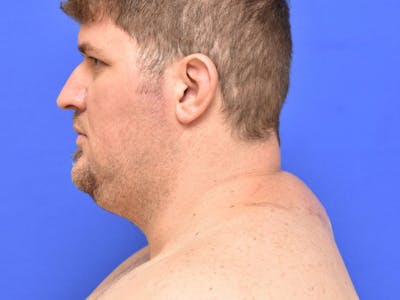 Buffalo Hump Before & After Gallery - Patient 389126 - Image 2