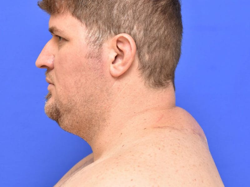 Buffalo Hump Before & After Gallery - Patient 389126 - Image 2