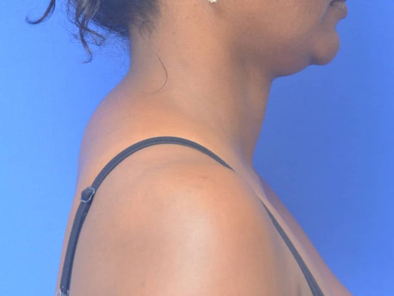 Buffalo Hump Before & After Gallery - Patient 289753 - Image 1