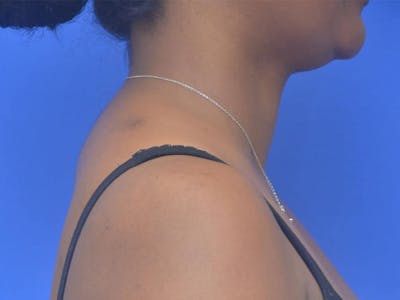 Buffalo Hump Before & After Gallery - Patient 289753 - Image 2