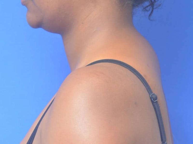 Buffalo Hump Before & After Gallery - Patient 289753 - Image 3