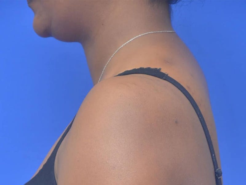 Buffalo Hump Before & After Gallery - Patient 289753 - Image 4
