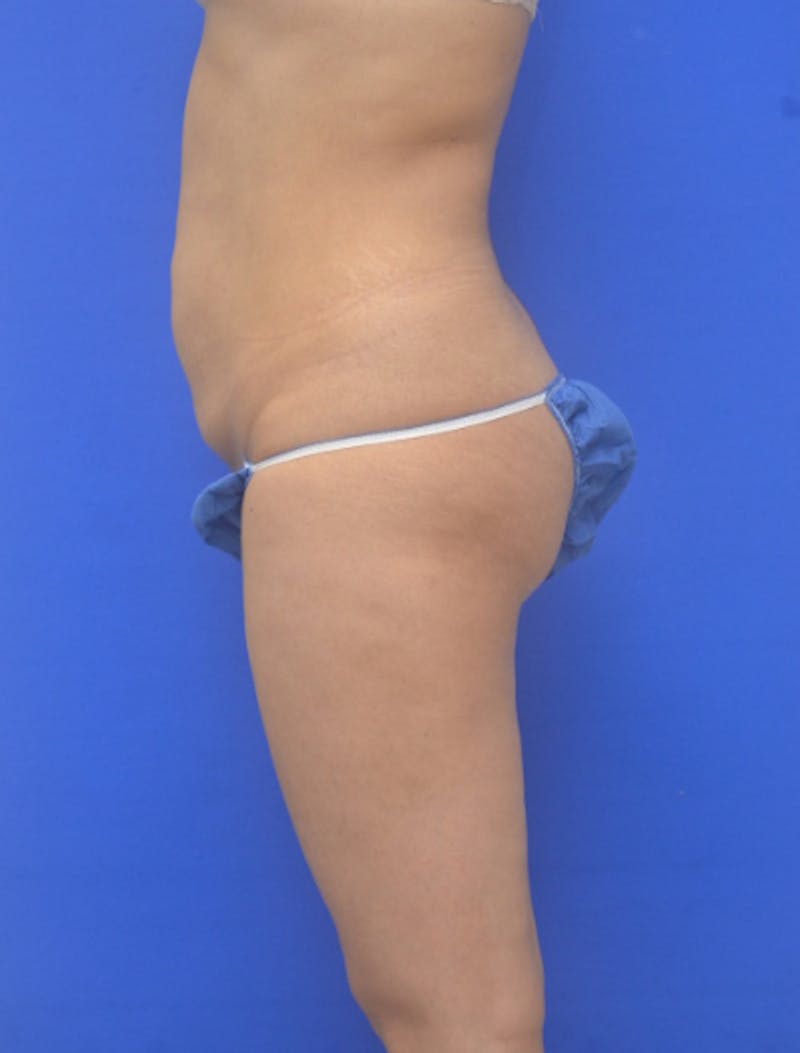 Liposuction Before & After Gallery - Patient 217730 - Image 5