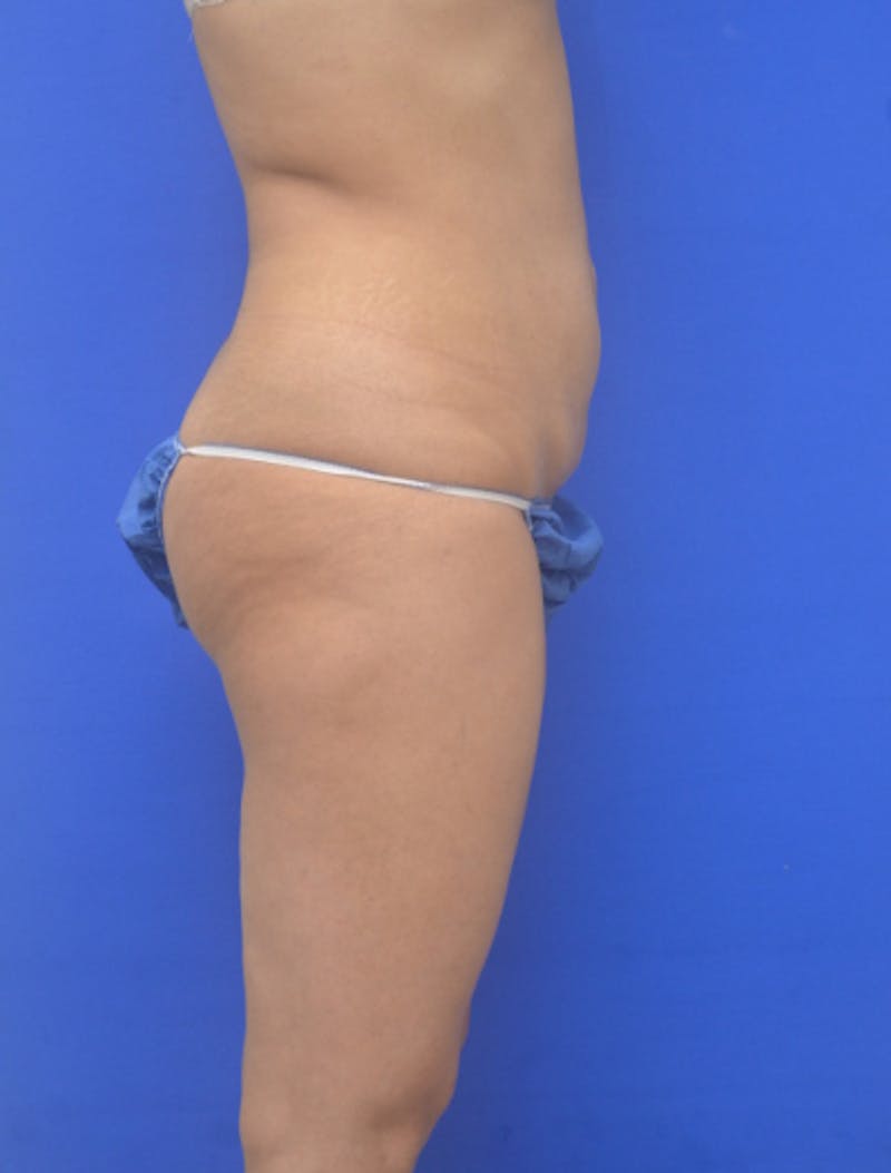 Liposuction Before & After Gallery - Patient 217730 - Image 7