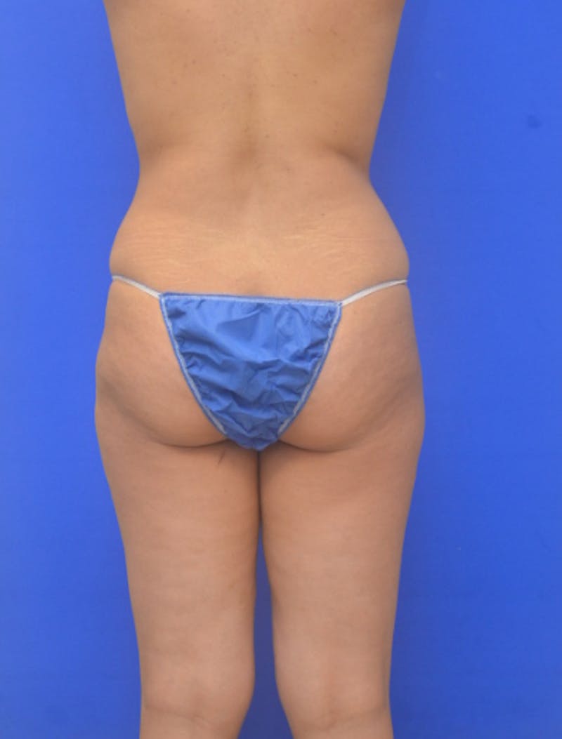 Liposuction Before & After Gallery - Patient 217730 - Image 9