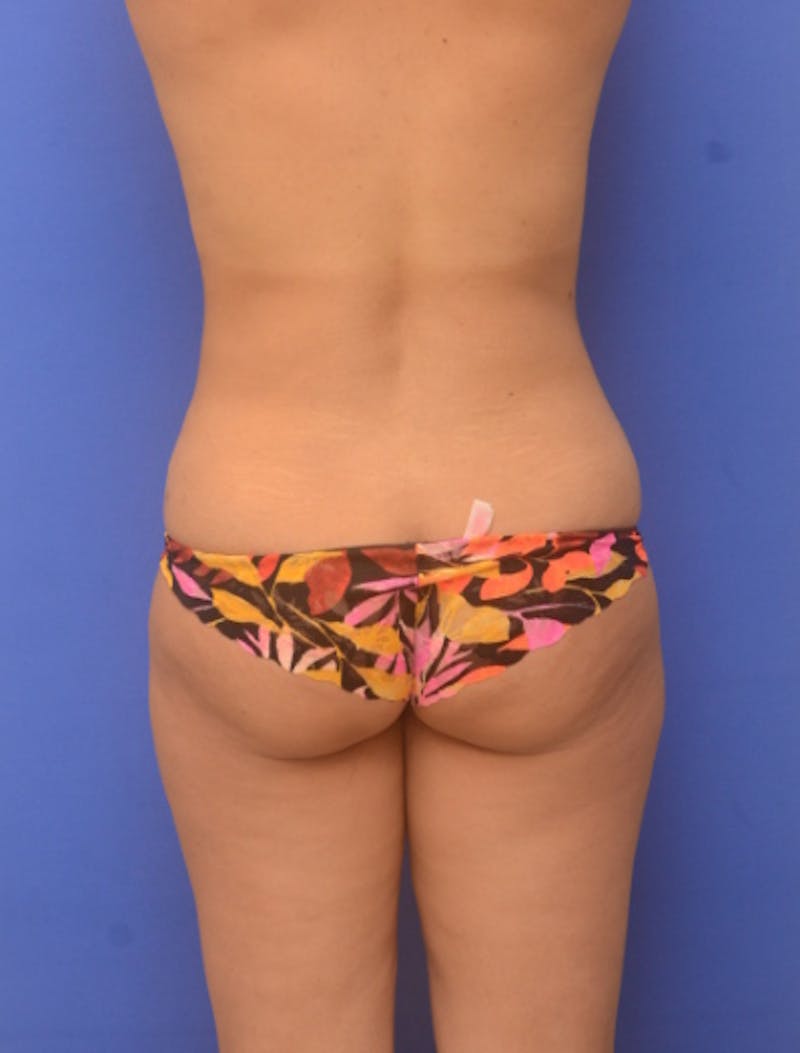Liposuction Before & After Gallery - Patient 217730 - Image 10