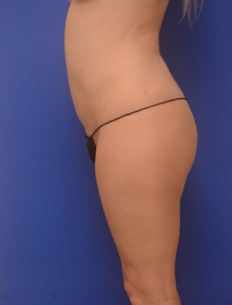 Liposuction Before & After Gallery - Patient 341601 - Image 6