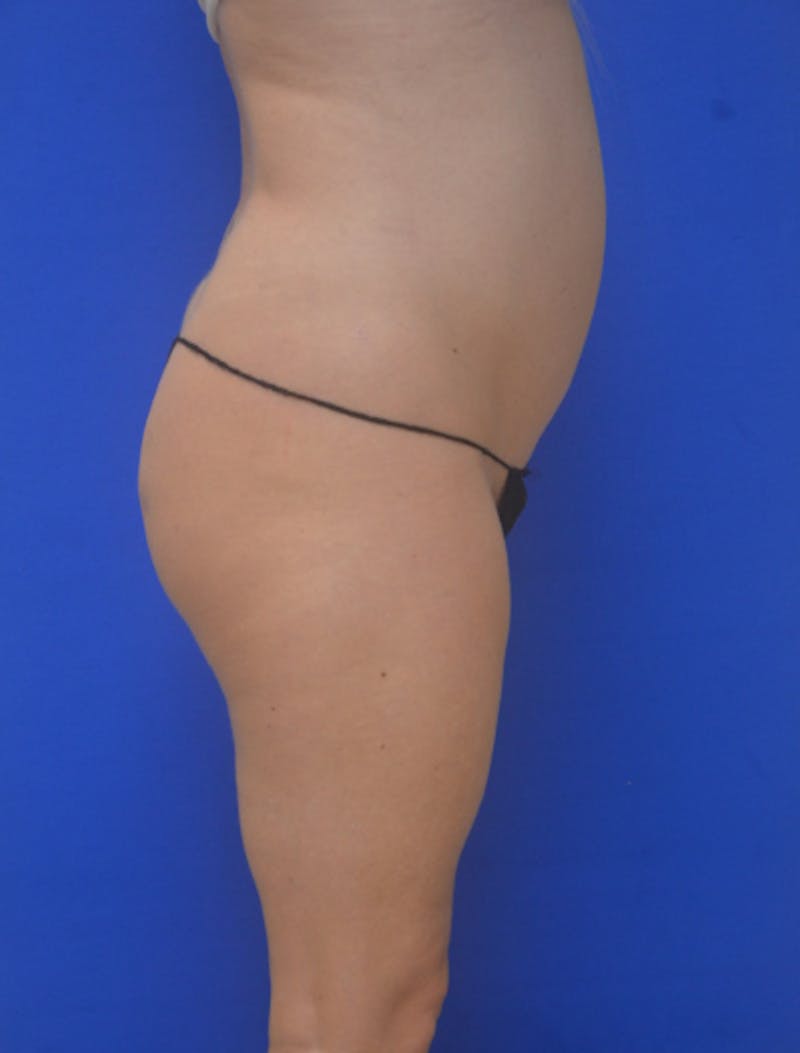 Liposuction Before & After Gallery - Patient 341601 - Image 7
