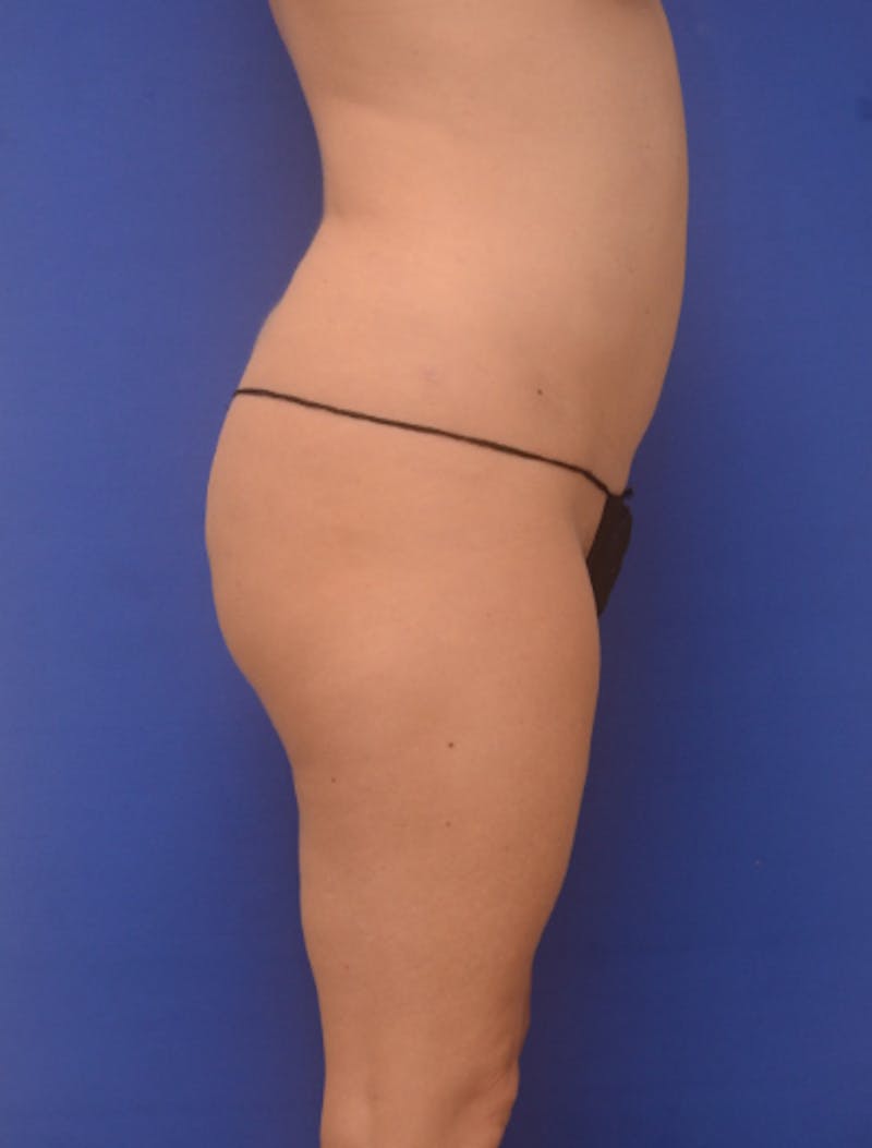 Liposuction Before & After Gallery - Patient 341601 - Image 8