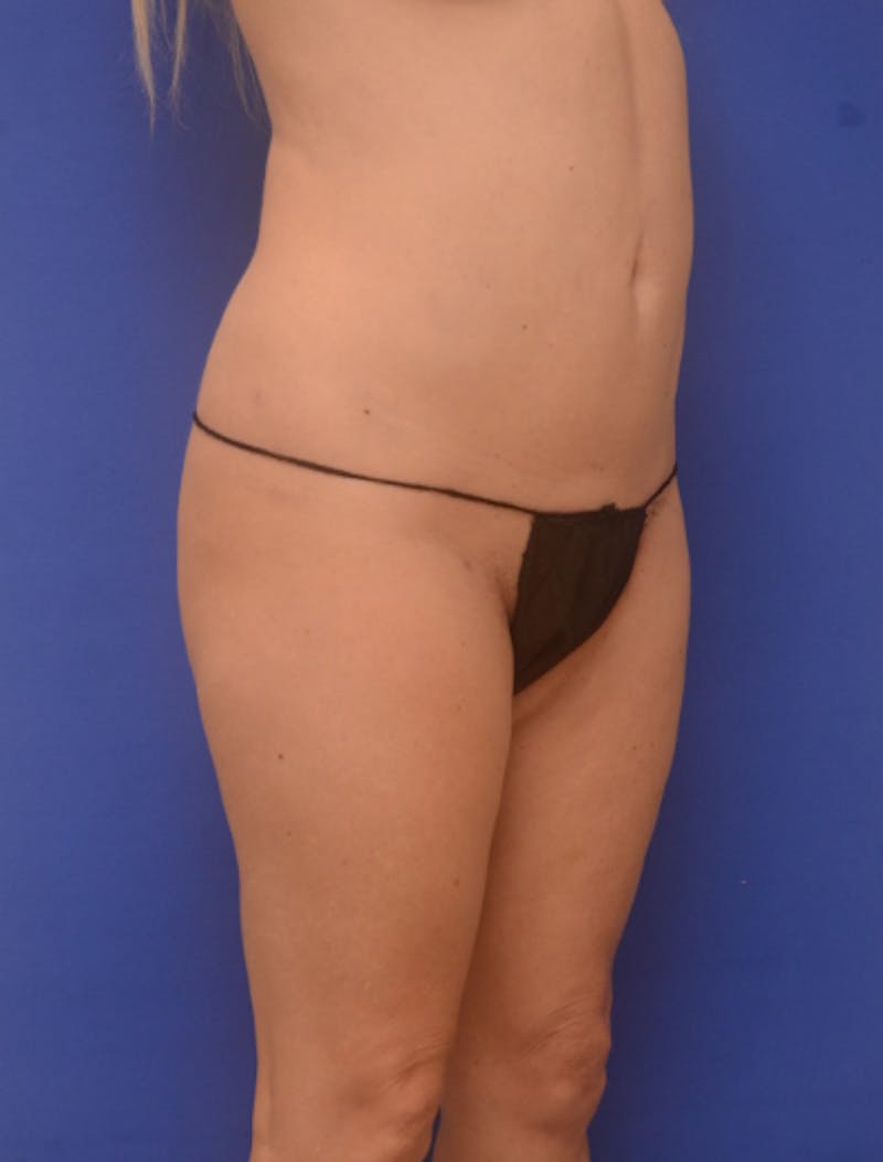 Liposuction Before & After Gallery - Patient 341601 - Image 10
