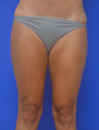 Liposuction Before & After Gallery - Patient 722410 - Image 2