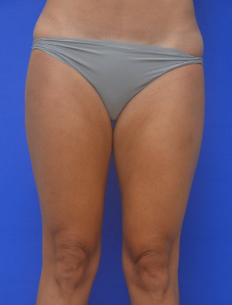 Liposuction Before & After Gallery - Patient 722410 - Image 2