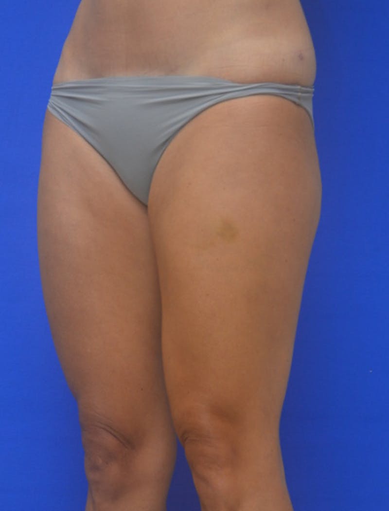 Liposuction Before & After Gallery - Patient 722410 - Image 4